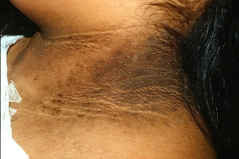 5 Dark Spots on Your Skin You Should Never Ignore