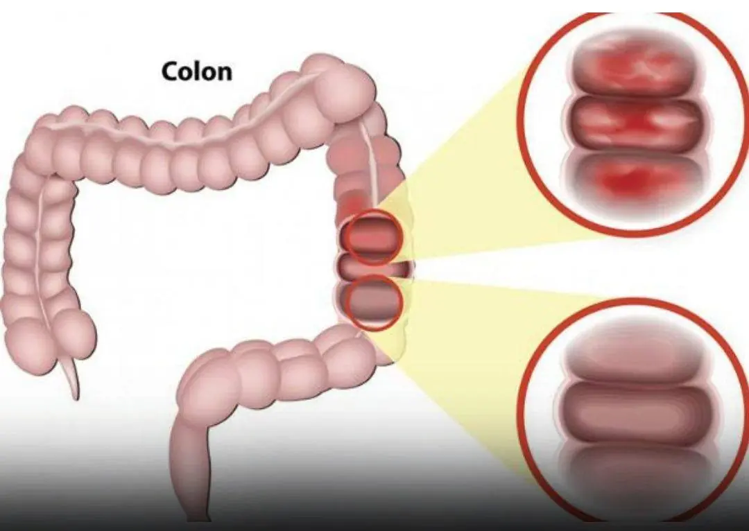 6 Subtle Signs of Early Colon Cancer (What Actually Matters — No Panic, Just Awareness)