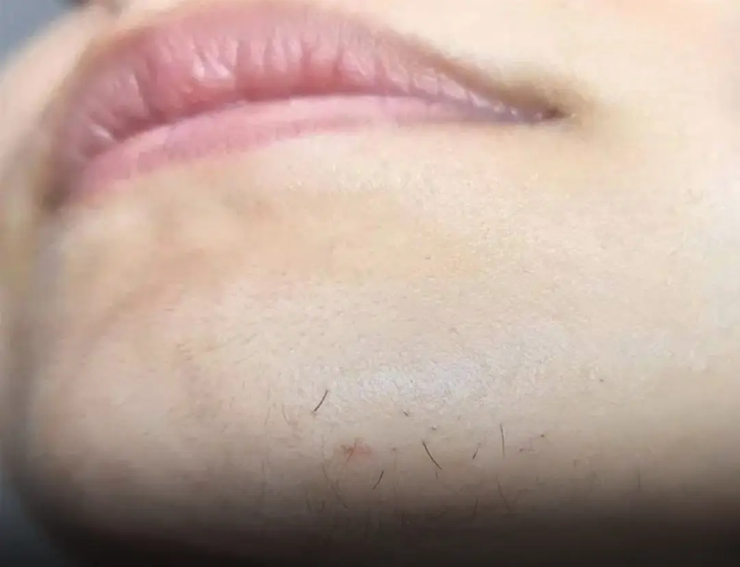 Chin Hair in Women: What It Actually Means (No Panic, Just Facts)
