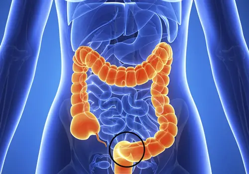 If you want to prevent colorectal can.cer - don’t miss this important information