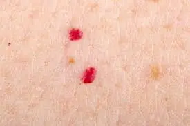 Seeing Red Dots on Your Skin? Here’s What They Could Mean