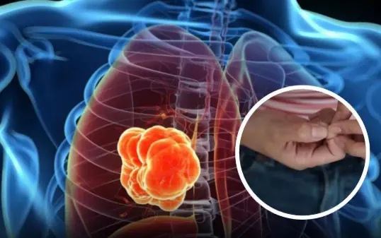 A Simple “Finger Test” at Home: Can It Really Detect Early Signs of Lu.ng Cancer?