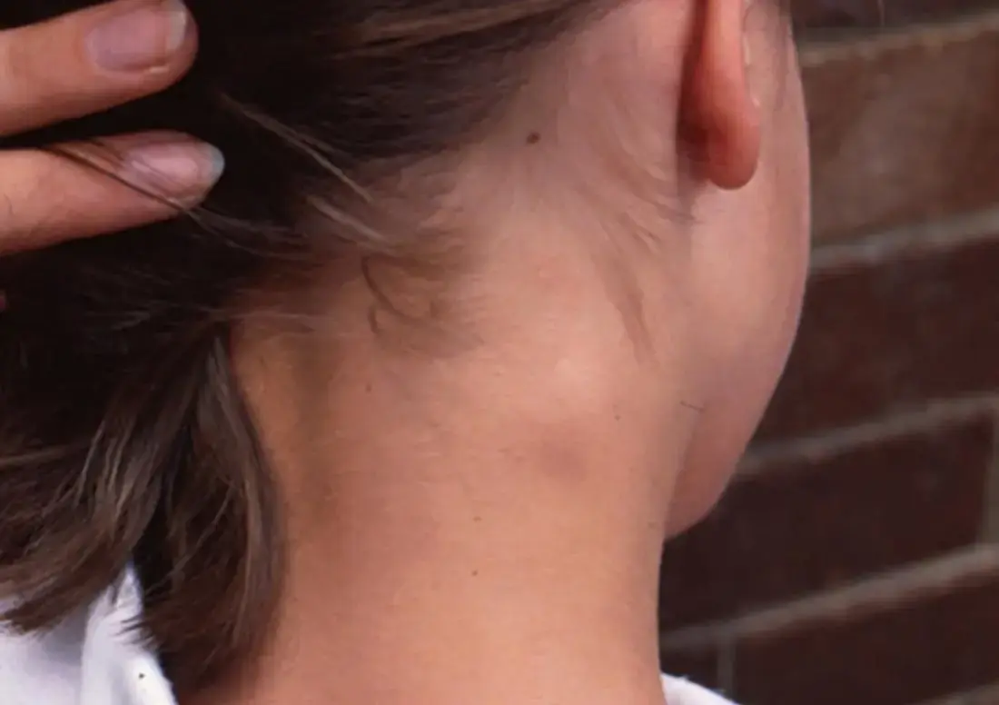 If You Notice a Lump on Your Neck, Back, or Behind Your Ear — Here’s What It Could Really Mean