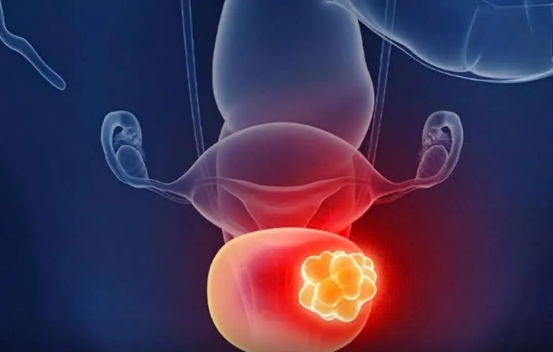 Bladder Ca.nc.er: 5 Subtle Early Symptoms You Should Never Ignore