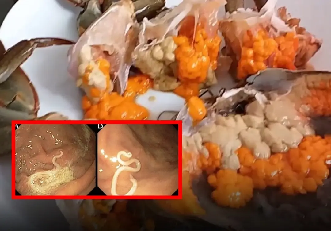 Doctors Identify 4 Foods That May Increase Your Risk of Parasites