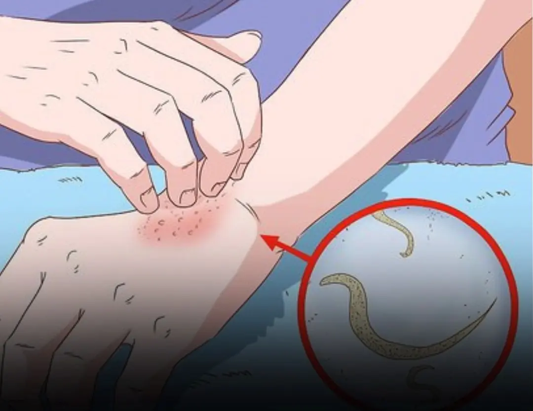 Warning Signs of Pinworm Infection You Should Never Ignore—and How to Prevent It