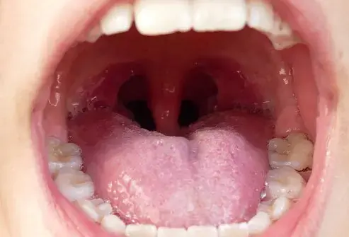 White Balls in the Throat? Doctors Explain What Tonsil Stones Really Are