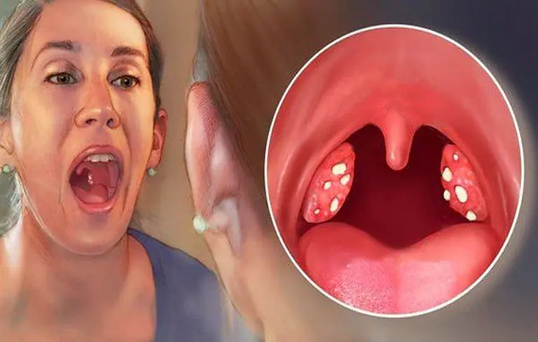 White bumps in your mouth? It might be linked to something you didn’t expect…
