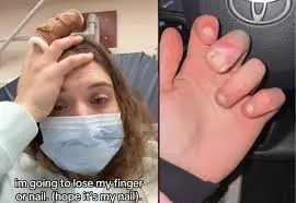 A 21-Year-Old Nearly Lost a Finger Because of This Common Nail Care Habit