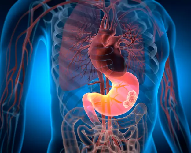 One Year Before Sto.mach Can.cer Develops, the Body May Send 4 Warning Signs—But 80% of People Ignore Them