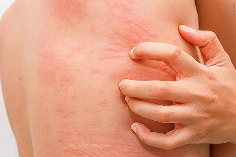 Persistent Itching Led to a Life-Changing Diagnosis: A Young Woman’s Story