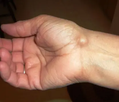 Unusual lump appears on the wrist: Don't ignore it because it could be a warning sign of a dangerous disease