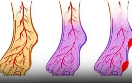 Struggling With Blood Pressure or Vein Problems? Try These 5 Life-Saving Habits Now!