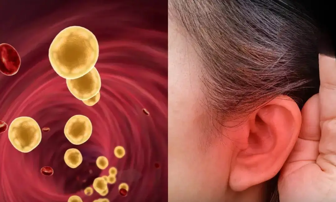 4 Warning Signs Your Body May Be Showing High Blood Fat Levels