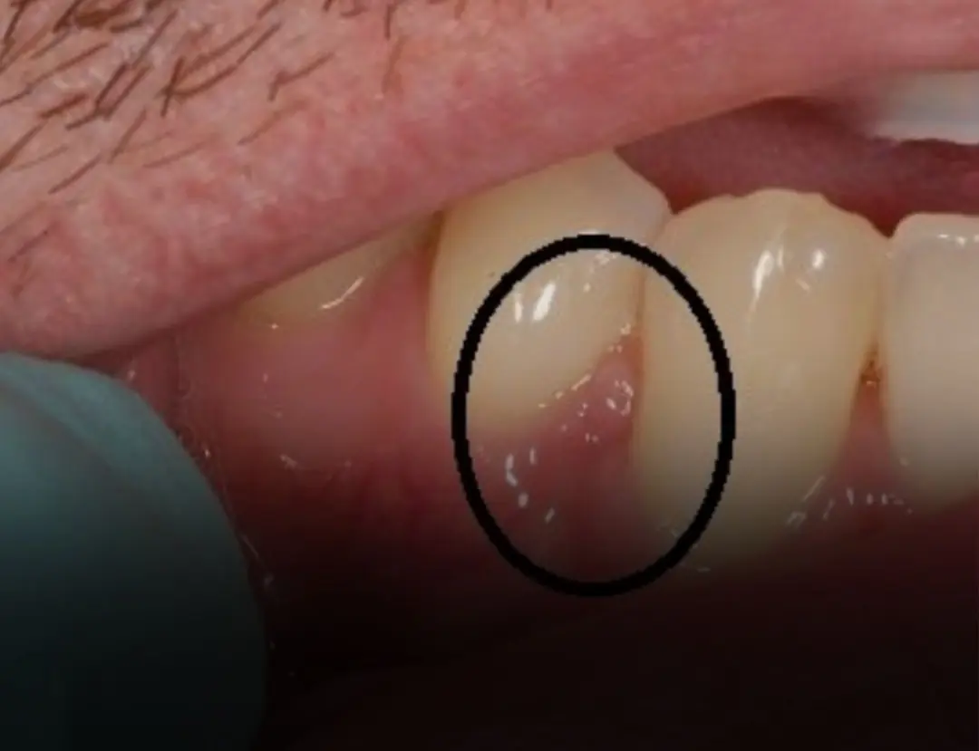 These are the initial symptoms of.