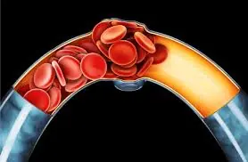 10 Signs to Be Aware Of That May Relate to Clogged Arteries