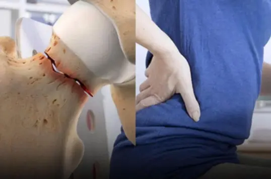 Osteoporosis—often called a “silent kil.ler” that requires serious attention.