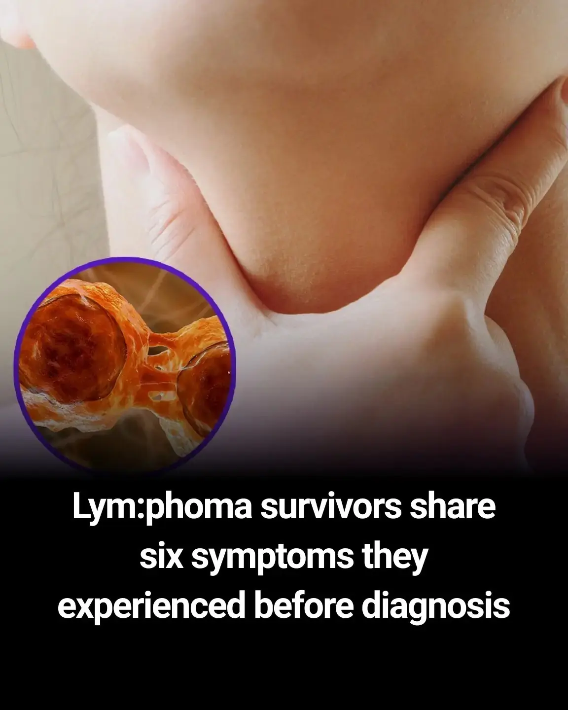 Lym.phoma survivors share six symptoms they experienced before diagnosis