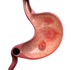 You May Be Slowing Your Ulcer Recovery Without Realizing It