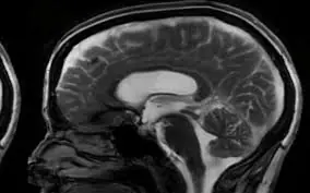 Your Body May Be Warning You Silently: Signs of an Aneurysm