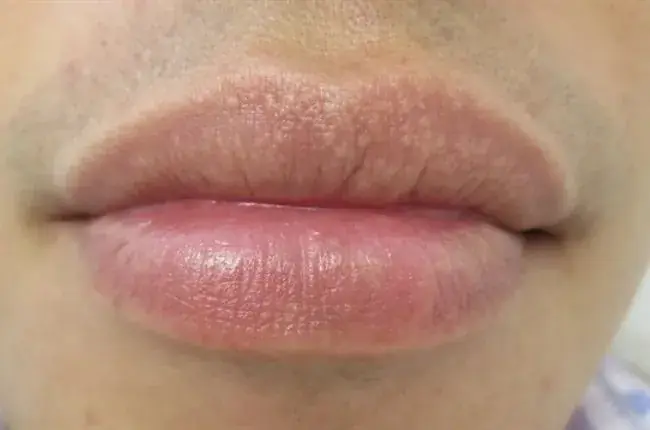 White Spots or Bumps on the Lips: Possible Causes and How to Treat Them