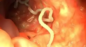 5 Uncomfortable Changes Your Body May Show When Parasites Grow Excessively