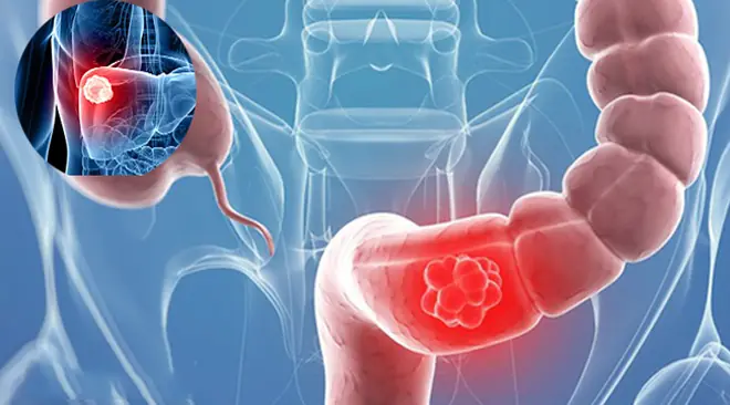 After a stage four colon can.cer diagnosis, a woman warns others about 5 symptoms she ignored