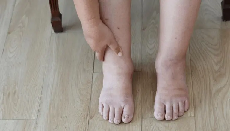 5 Essential Nutrients That Help Reduce Swelling in Feet and Legs