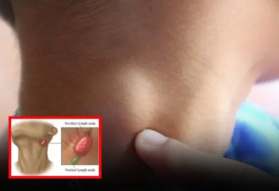 Ne.ck Swe.lling and Lymph No.des: Know When It’s Time to Act