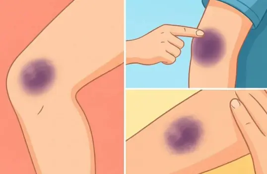 Unexplained bruises on your body? Here’s what they could really mean