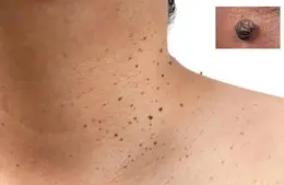 Noticing Tiny Bumps on Your Neck? Here’s What You Should Know