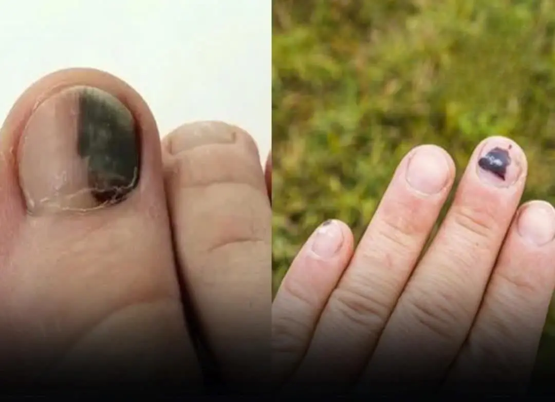 Can:cer Warning: 3 Subtle Limb Changes You Should Never Ignore