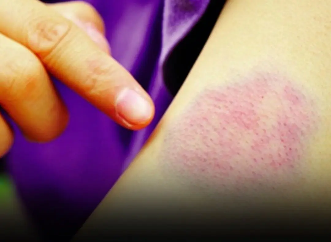 When Bruises Appear Without Reason: What Doctors Want You to Know