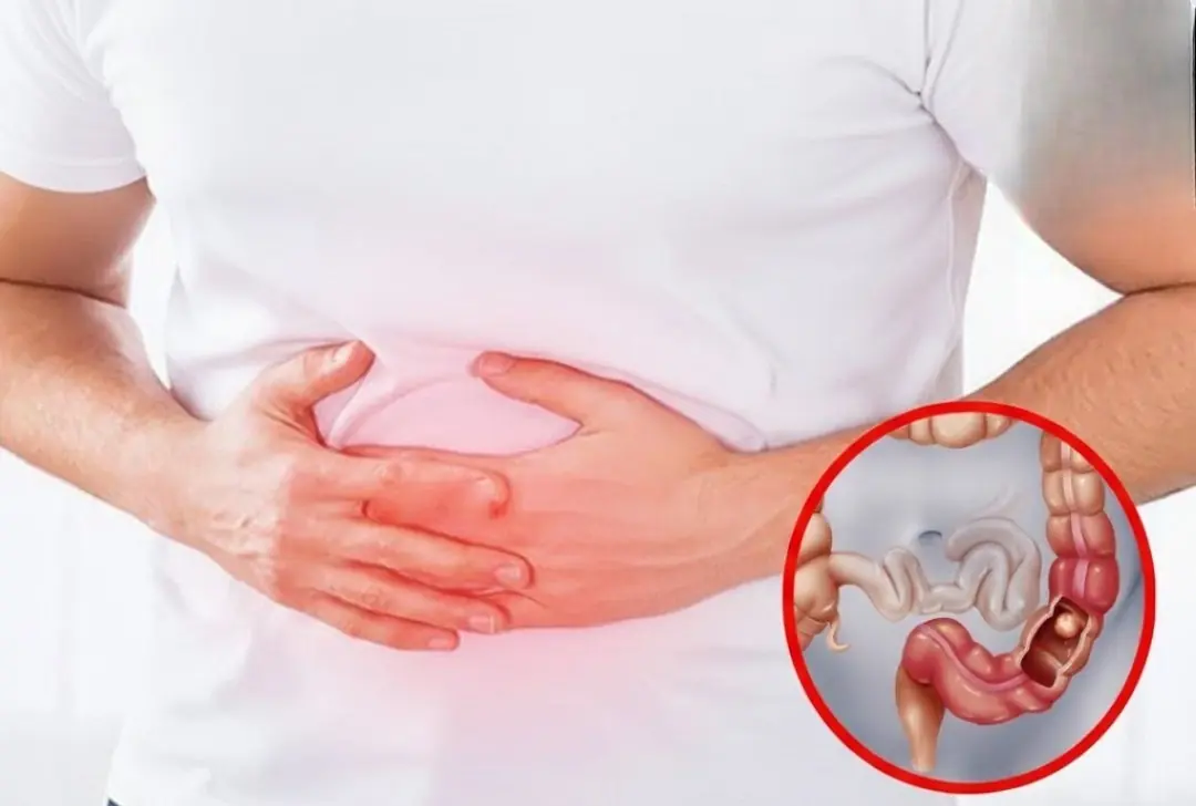 6 EARLY SIGNS OF COLON CANCER (STAGE 1) YOU SHOULD NOT IGNORE
