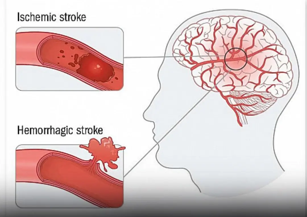 A silent stroke can strike when you least expect it — these small habits could save your life.
