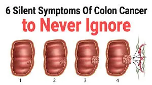 6 Early Signs of Colorectal Cancer You Should Be Aware Of