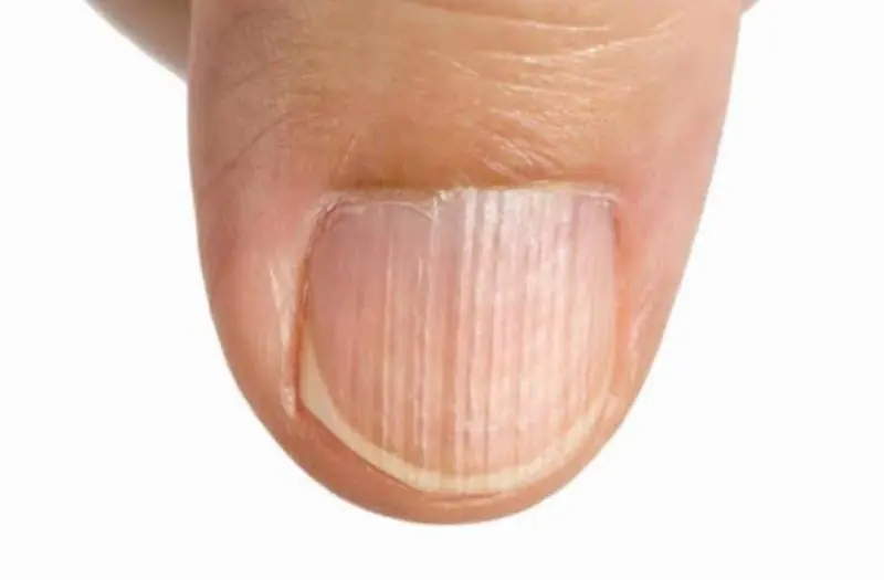 10 Nail Changes You Should Never Ignore: Signs Your Body May Be Sending
