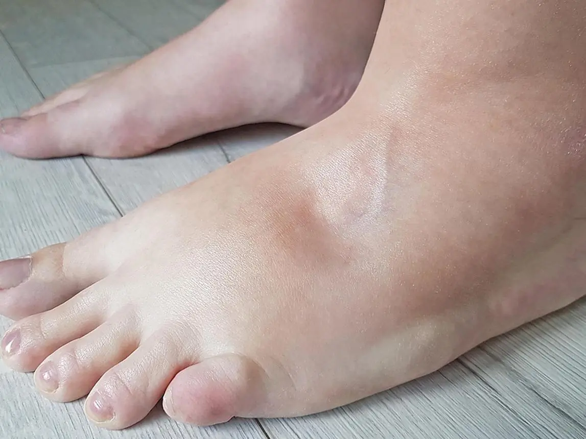 6 Simple Ways to Reduce Water Retention Naturally and Effectively