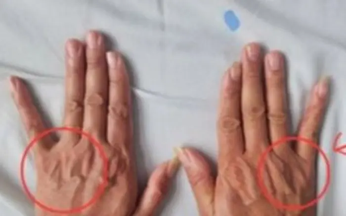 When veins trace clearly beneath the skin, it’s often a sign that you are...