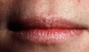 Noticing white bumps on your lips or private area? Here’s what it could mean