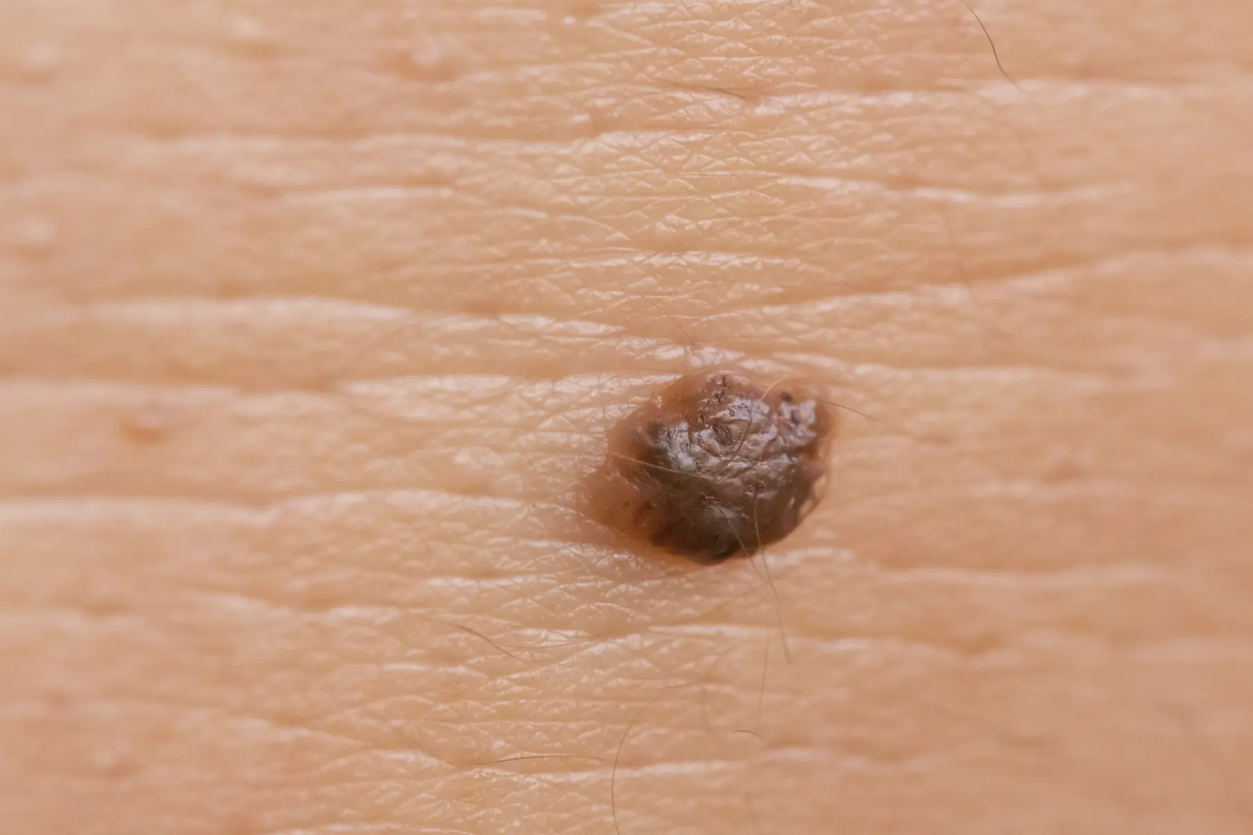 My Mole Suddenly Looks Jagged — Should I Be Worried?