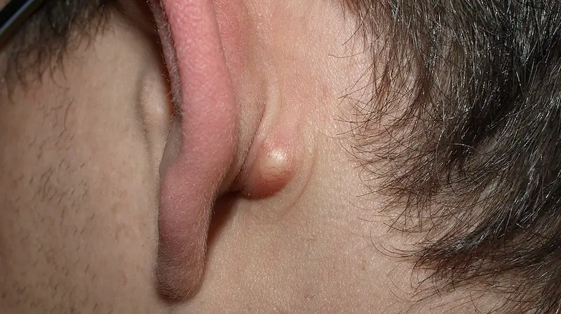Sebaceous cysts explained: Main causes and home remedy solutions