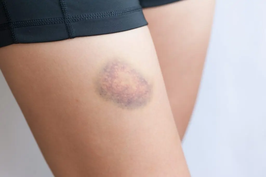 Be Careful If You Notice These Bruises on Your Body – Here’s What They Might Mean