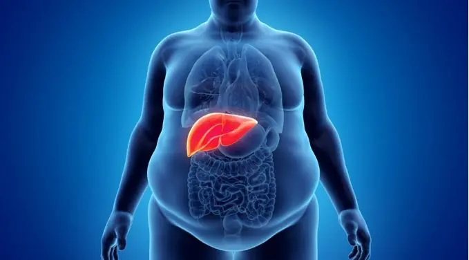 Not all belly size is fat: ways to tell belly fat apart from liver disease