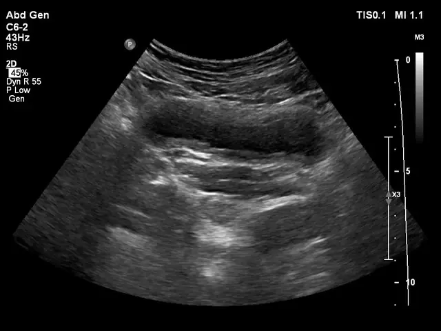 42-Year-Old Woman Hospitalized After Passing Blo.od in Urine — Doctors Warn About 4 Common Summer Habits Many Women Ignore