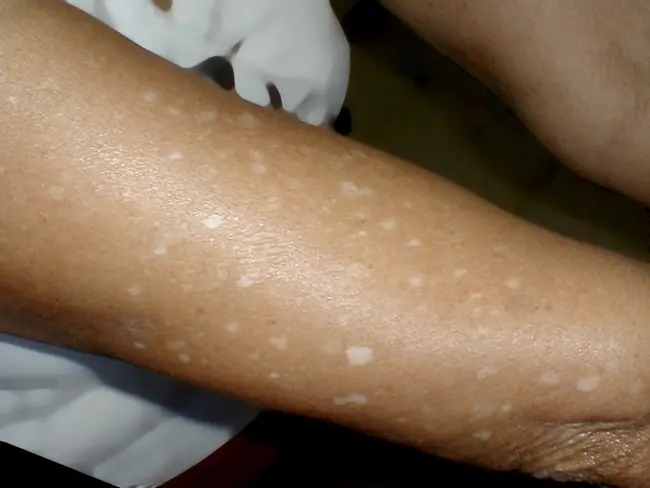 What are those little white spots on your arms or legs? A specialist finally explains