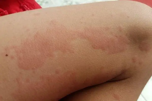 Why are you getting hives? Hidden causes you might be overlooking