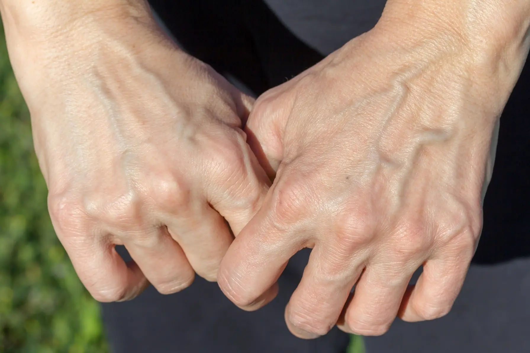 If Your Veins Are Visible, What Does It Really Mean? Experts Explain