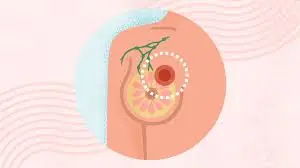 Your Body May Show Early Signs of Breast Cancer Up to 1 Year Before Diagnosis