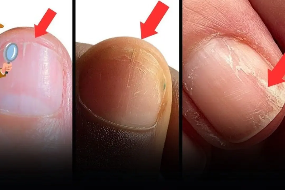 Do Your Nails Keep Breaking or Splitting? It Could Be a Warning Sign From Your Body.